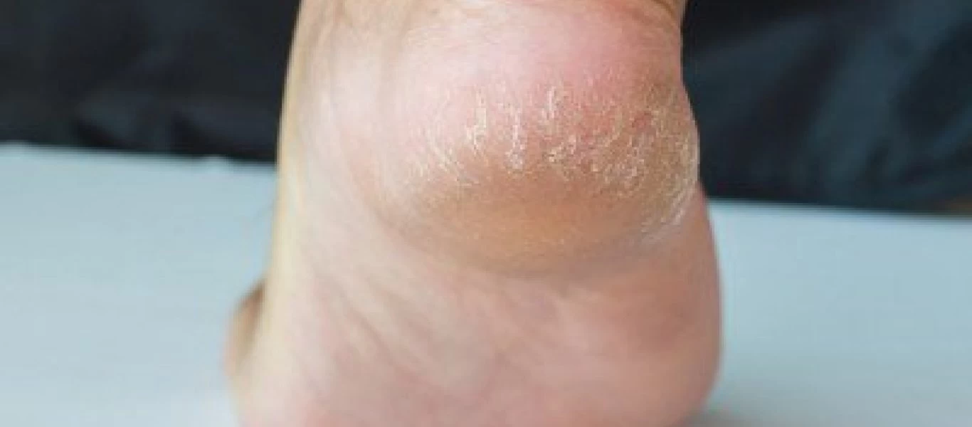 «Σκασμένες» φτέρνες: Η συνταγή που θα σας απαλλάξει μια και καλή